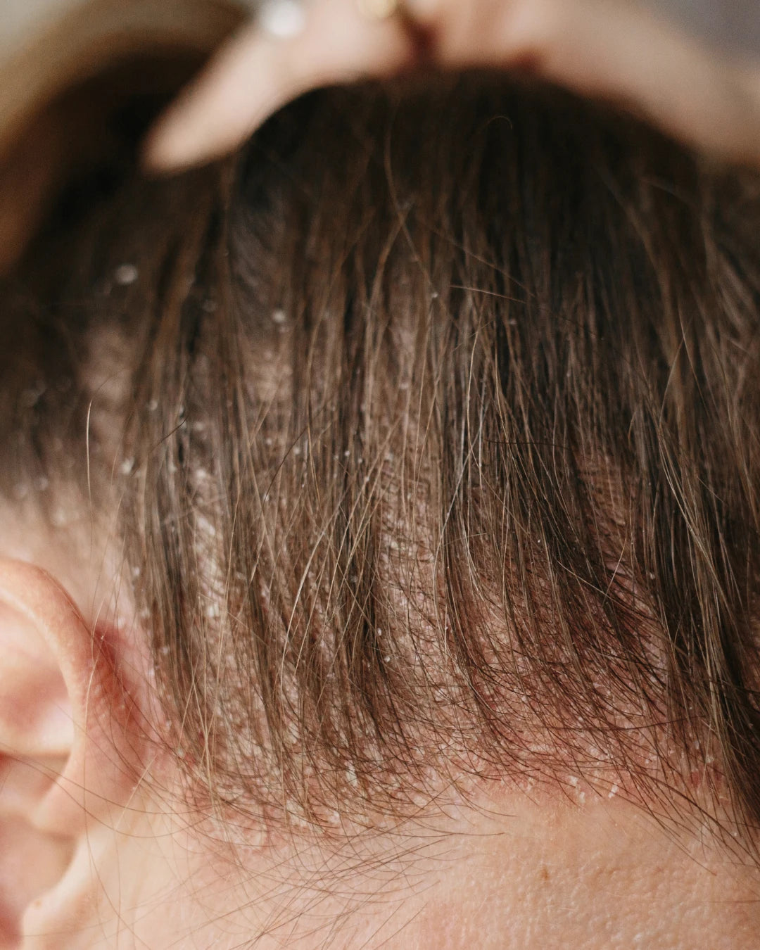 Dandruff + Itchy Skin and Scalp